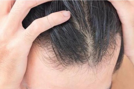 肾虚脱发 肾虚脱发